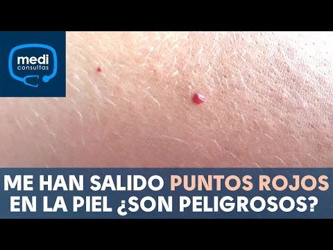 Me han salido puntos rojos en la piel ¿son peligrosos? #MediConsultas