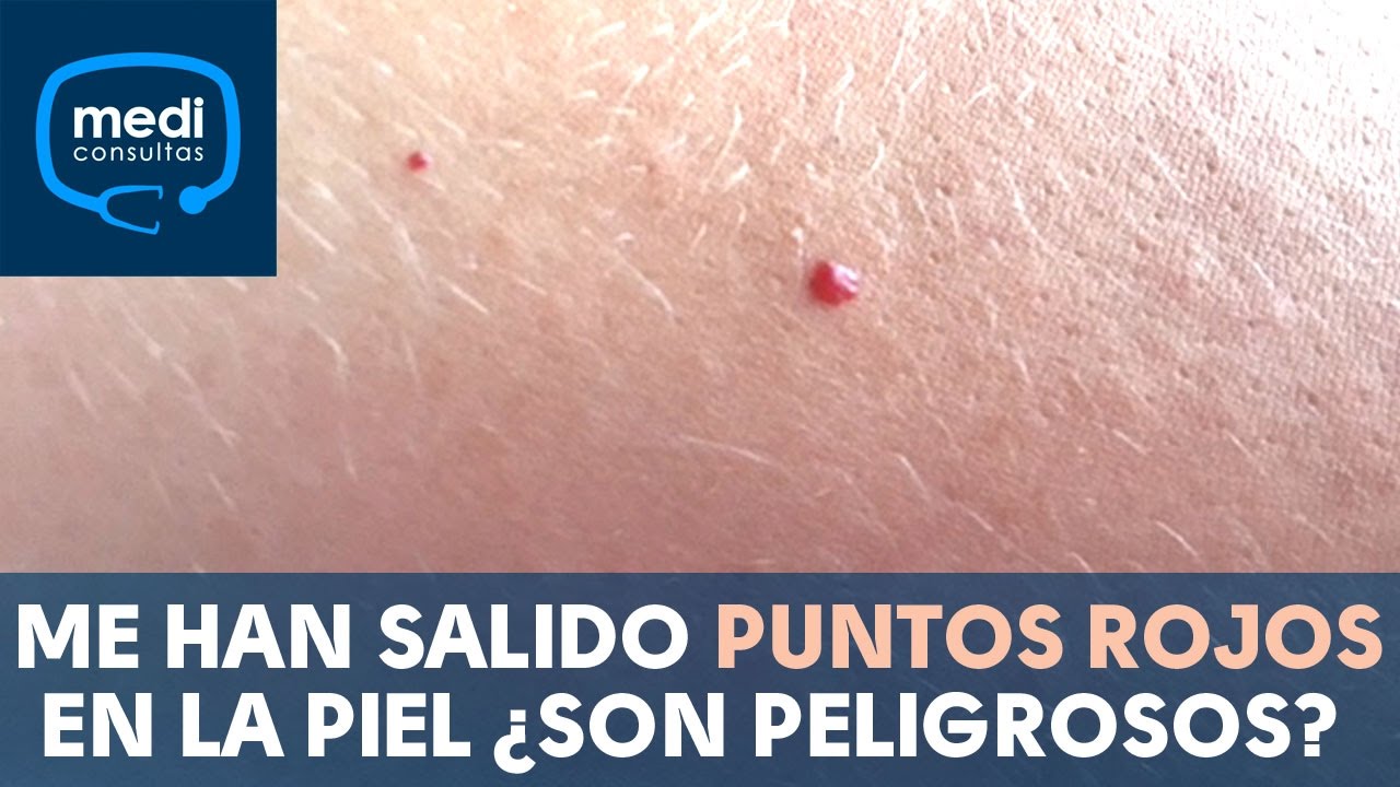 Watch Me han salido puntos rojos en la piel ¿son peligrosos #MediConsultas Now Me han salido puntos rojos en la piel ¿son peligrosos #MediConsultas