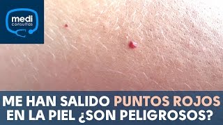 Me han salido puntos rojos en la piel ¿son peligrosos #MediConsultas