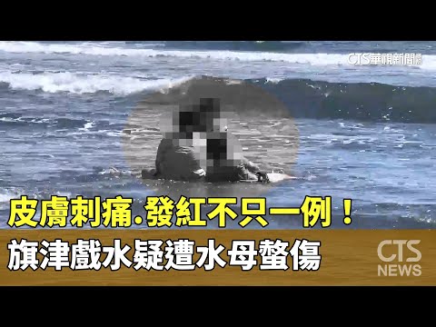 皮膚刺痛.發紅不只一例！　旗津戲水疑遭水母螫傷