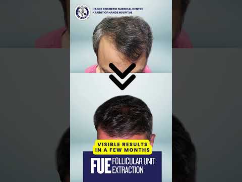 Hande FUE Hair Transplant od