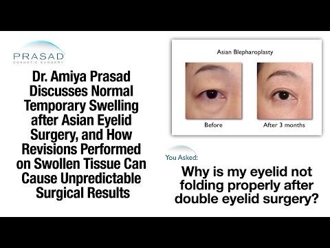 二重まぶた手術の腫れが解消するまでに何ヶ月もかかる理由＆修正前の忍耐力 (Why Double Eyelid Surgery Swelling can Take Months to Resolve, & Patience before Any Revision)