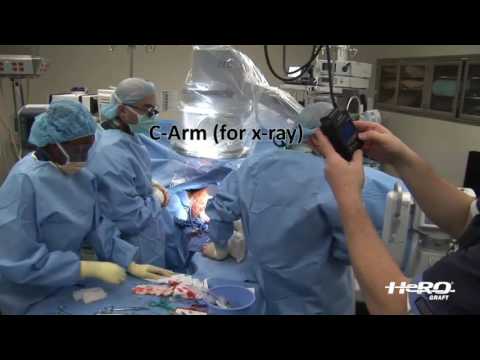 HeRO® Graft - Surgical Implant with Dr. Glickman