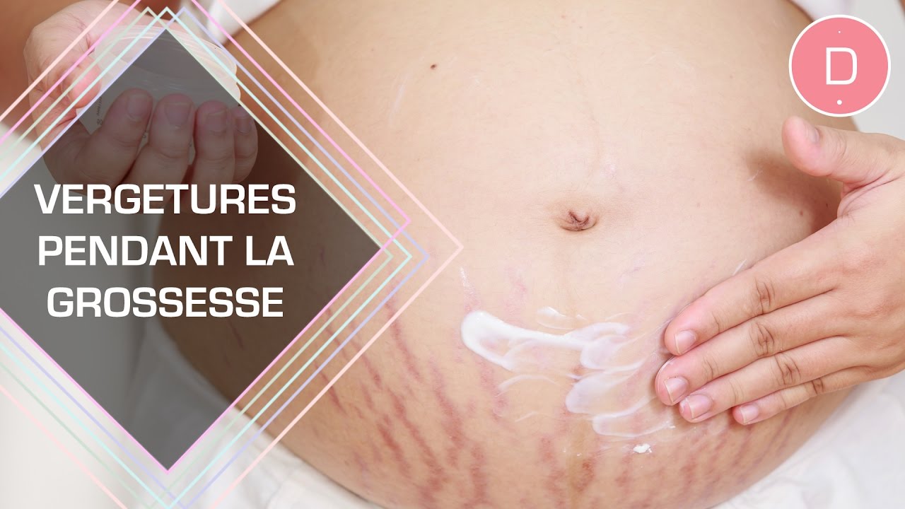 Les vergetures pendant la grossesse - Beauté & Grossesse