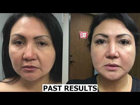 Ferrer Aesthetics Offers Ultherapy Double Chin Treatment or Face Lift & Consultation - Second Medium