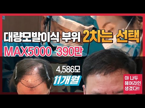 야 나두 모발이식 헤어라인 생겼다.MAX5000  390만원 4,586모 이식 전 후