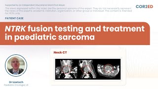 NTRK fusion testing and treatment in pediatric sarcoma