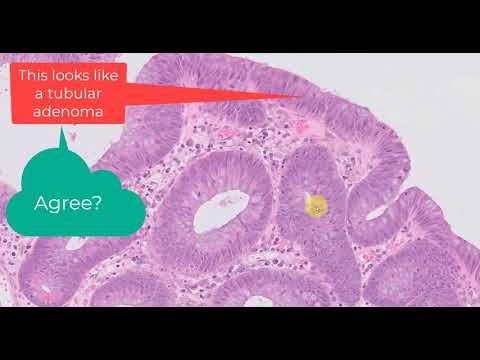 Colonic manifestations of Juvenile polyposis syndrome