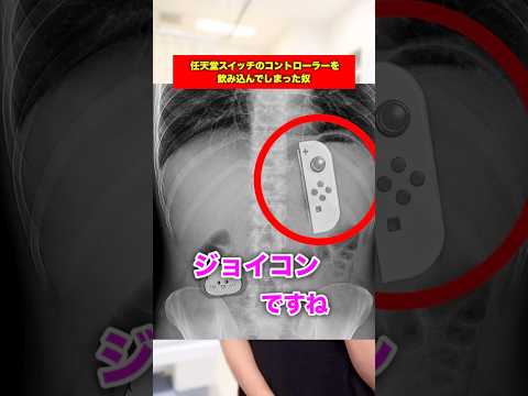 任天堂スイッチのコントローラーを飲み込んでしまった男www