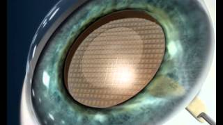Cirugía de cataratas con láser - Centro de Oftalmología y Cirugía Ocular Dr. Torres Imaz