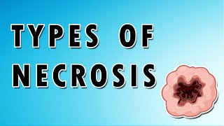 Apoptosis vs Necrosis
