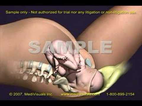 Shoulder Dystocia Injury: 3D Medical Animation