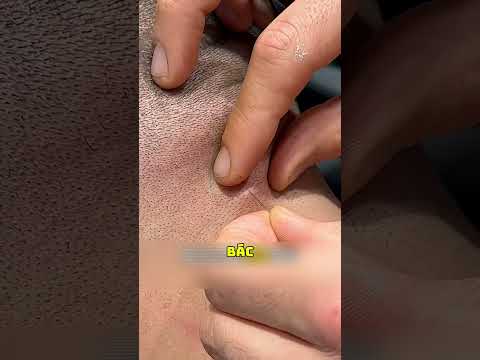 Hiện Tượng Lạ Ở Da Đầu