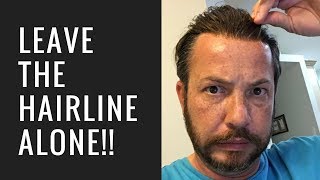 Hair Replacement Hair System Review Leave the Hairline Alone!!