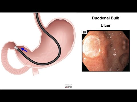 HCC 1475-6-Small Intestine Pathology Endoscopy Findings
