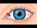 What Are The Ugly Yellow Spots In My Eye? | An Optometrist Explains | True Eye Experts