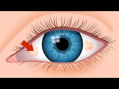 Ugly Yellow Spots - Tampa FL Eye Doctor 813-632-2020