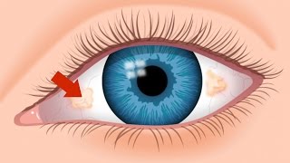 Ugly Yellow Spots - Tampa FL Eye Doctor 813-632-2020