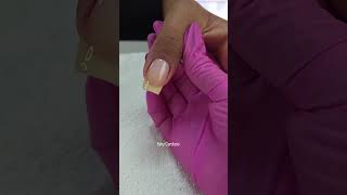 Nova técnica de Cutilagem