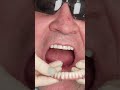 Dental implant’s All on 4 v Praze #shorts #dentist #dental #implant #veneers