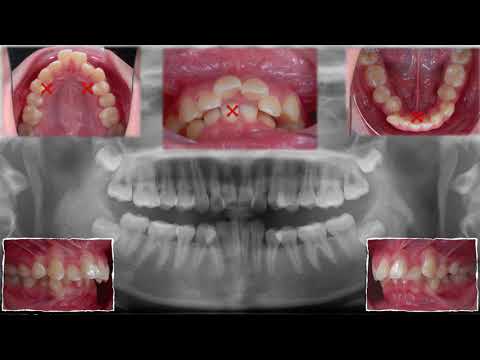 Chris' Top 11 Cases: 4. Class II, Excessive Overjet and Deep Bite｜【Chris Chang Ortho】CC456