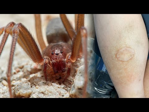 Brown Recluse Spider Bite Story 🕷 They Nearly Lost Their Leg!