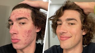 my struggles with acne