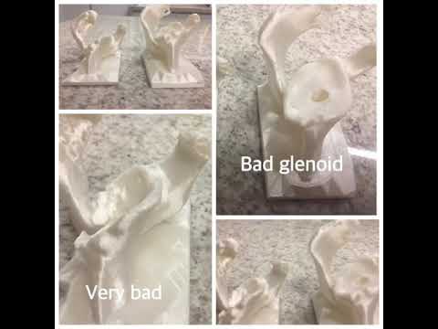 Glenoids for planing reverse total shoulder arthroplasty