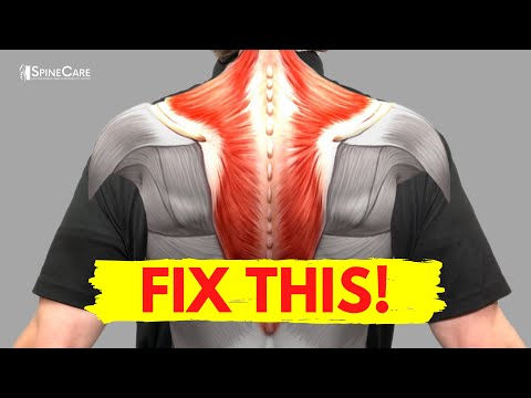 Exercises to Relieve Muscle Knots in the Neck & Shoulders