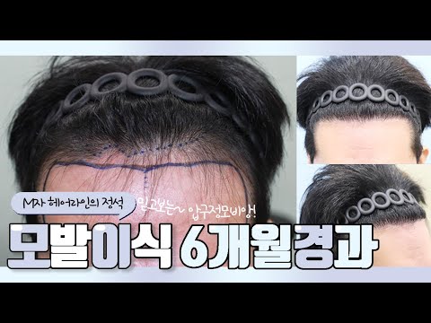 20대 초반 남성,비절개,3500모,M자 모발이식 6개월 경과영상!