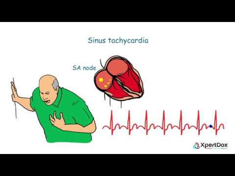 Tachycardia hipertóniával - A szívritmuszavarok (arrhythmiák) típusai