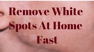 Remove White Spots On Face Only 3 Remedies