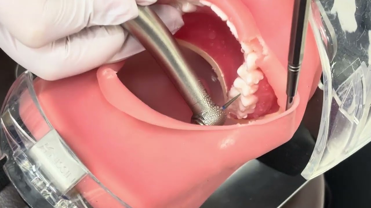 マンツーマンセミナー：左上6番支台歯形成(1/14)受講生によるスライスカット。スライスがしきれなかった