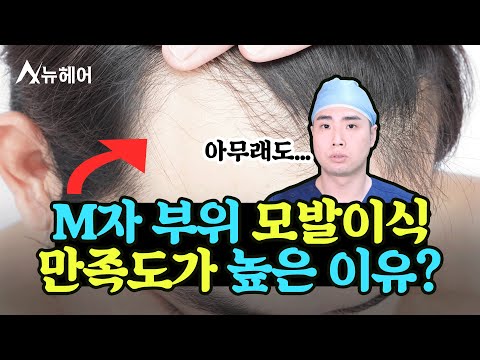 M자이마 모발이식, 효과가 좋은 이유는?ㅣ뉴헤어