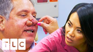 Man Struggling To Breath With His Severe Rhinophyma | Dr Pimple Popper