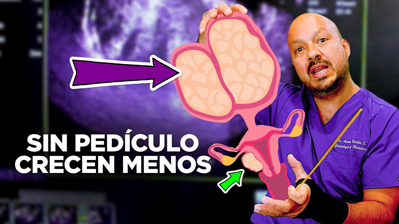 Intramural vs Subserous Pedicled Fibroid