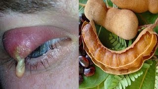 आँखों की गुहेरी जड़ से मिटाने का उपचार  | How To Get Rid Of Eye Stye