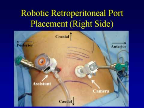 Nefrectomía retroperitoneal asistida por robot