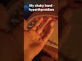 my shaky hand - hyperthyroidism - hand tremor