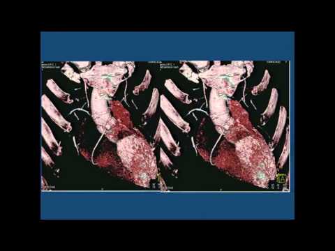 Case Series: Complications of Cardiac Surgery