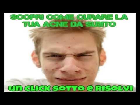 Cura di psoriasi principale da omeopatia Le ragioni di dermatite atopic ad adulti