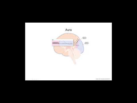 Phases of a Migraine Attack