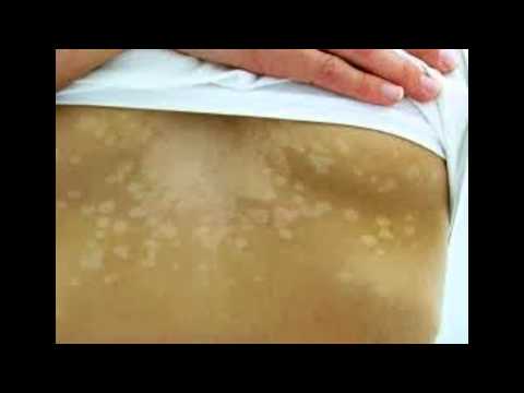 comment traiter pityriasis versicolor