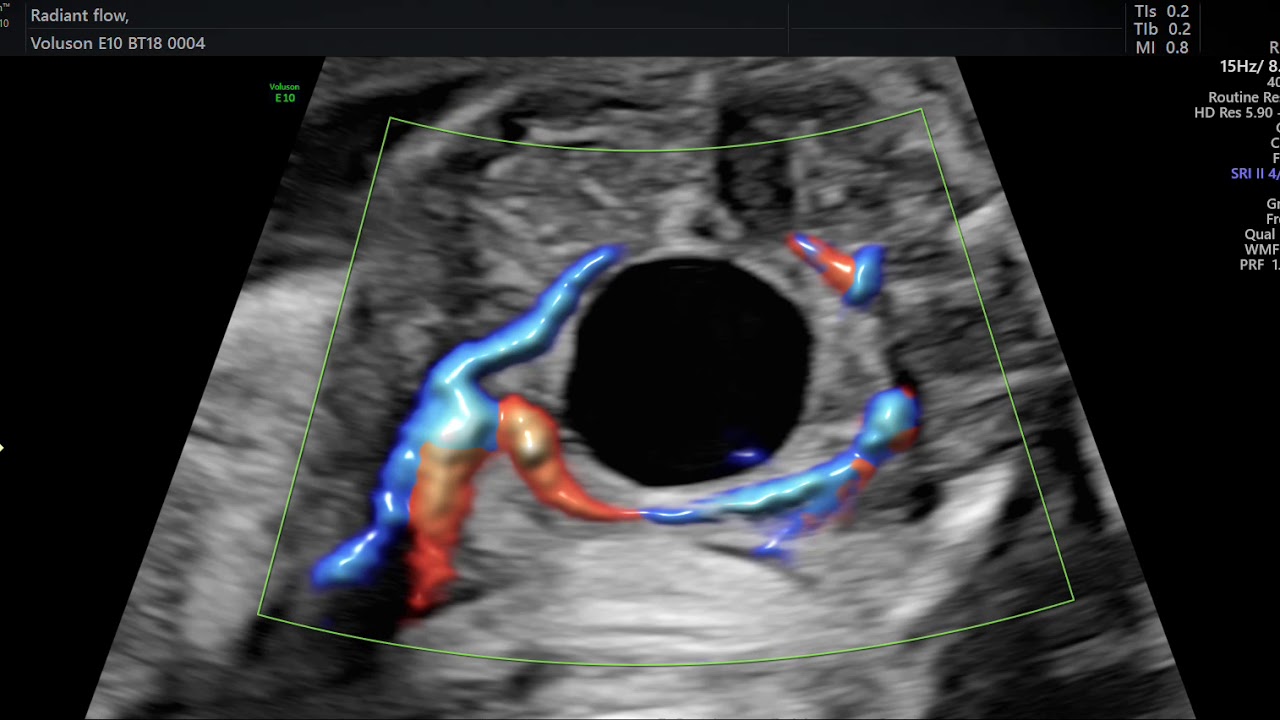 AVALIAÇÃO DE BEXIGA FETAL EM ULTRASSON OBSTETRICO