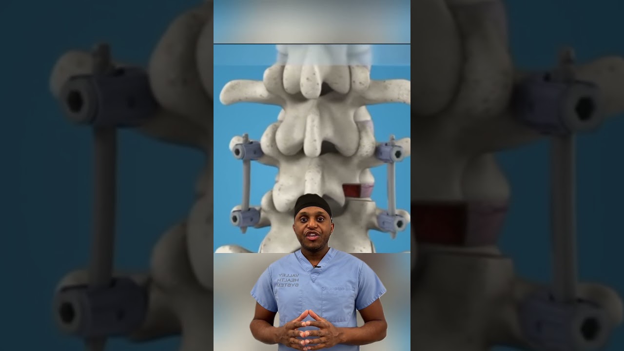 Mazor Robot CHANGED Spine Surgery