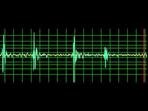 Prosthetic Mitral Valve Closing Click- normal speed