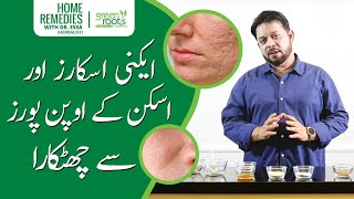 Acne Scars aur skin ke open pores se chutkara Dr Essa ki remedy se | Green Roots | Home Remedy
