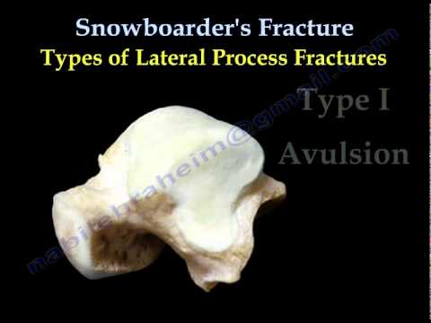 TALUS FRACTURE ,SNOWBOARDER'S injury- Everything You Need To Know - Dr. Nabil Ebraheim