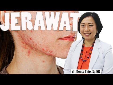 VIDEO Cara Alami Menghilangkan Jerawat Di Rahang Yang Lagi  