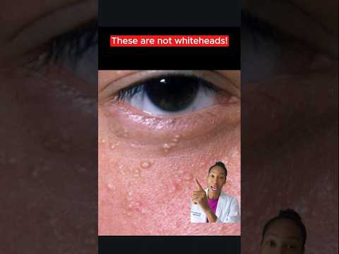 Milia Vs. Whiteheads: Know the Difference | Dermatologist Explains #skincare